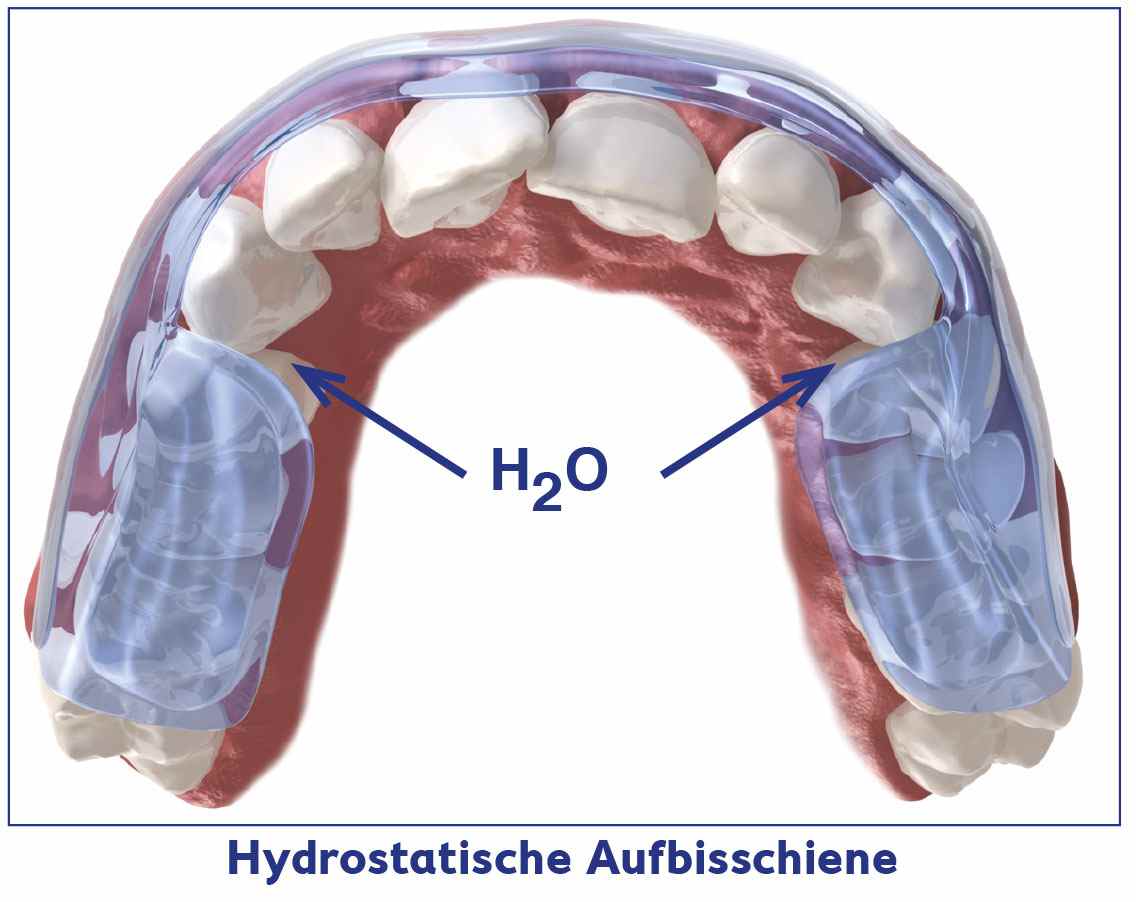 Picture of a denture half with the hydrostatic Aqualizer as bite splint