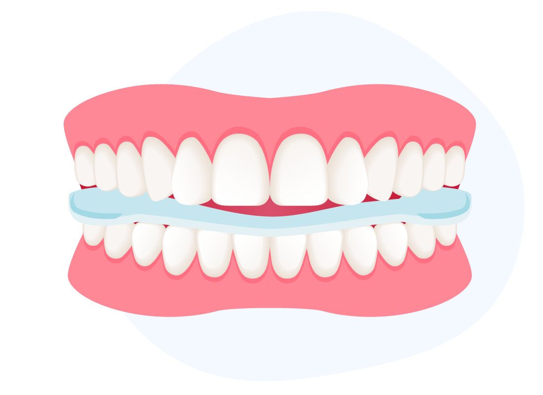Grafische Darstellung von einem Gebiss, das eine Aqualizer Gebissschiene zwischen den Zahnreihen sitzen hat