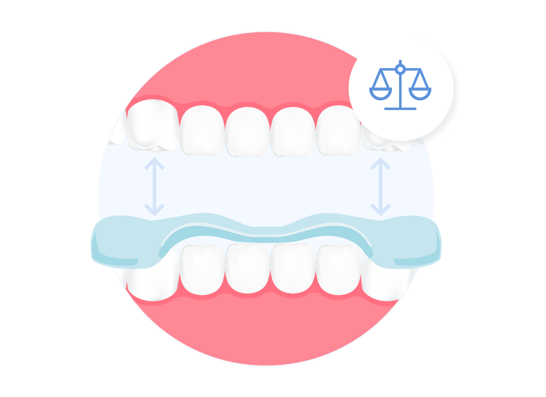 Grafische Darstellung der oberen und unteren Zahnreihe mit der Auflage einer Aqualizer Bissschiene