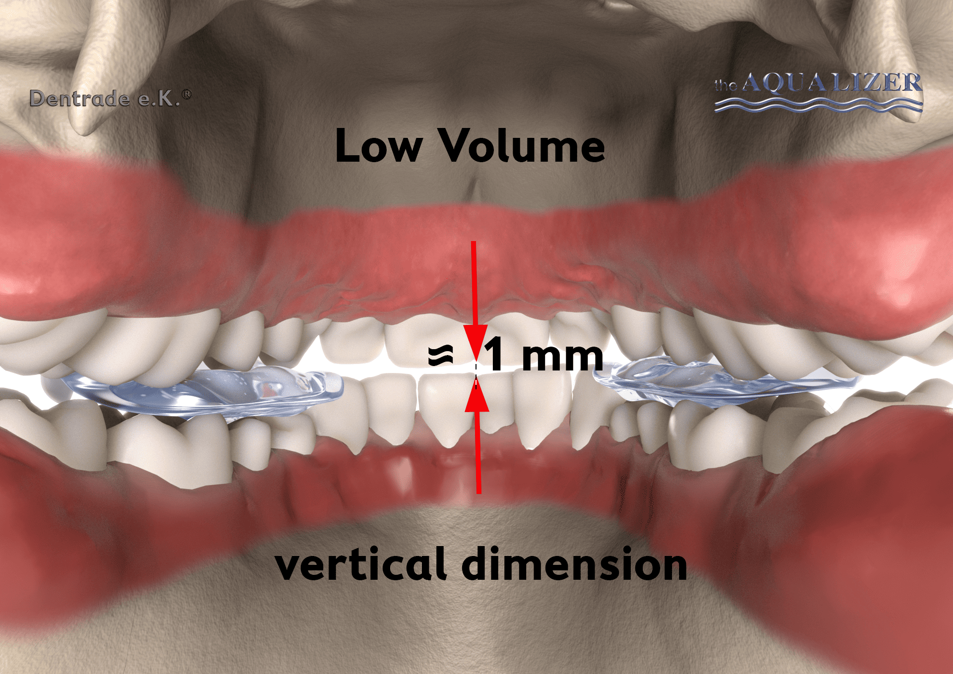Illustration of a bite cavity with two pads on the molars, which provide a distance of about 1 mm
