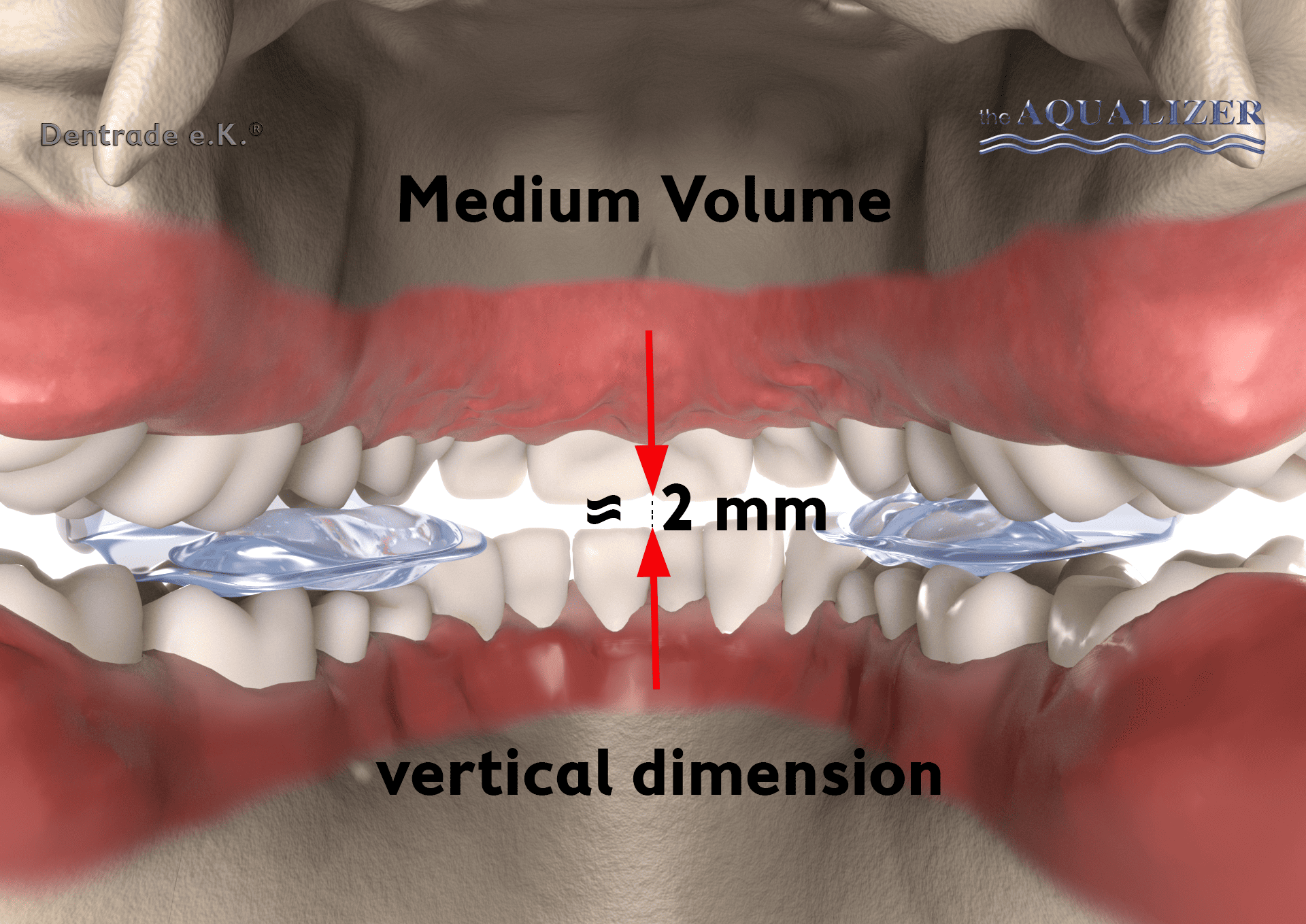 Illustration of a bite cavity with two pads on the molars, which provide a distance of about 2 mm